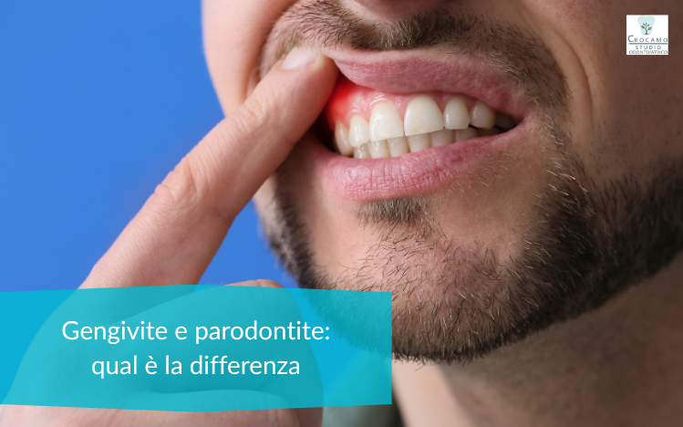 gengivite e parodontite