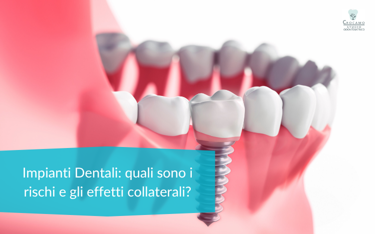 impianti dentali: cosa sapere
