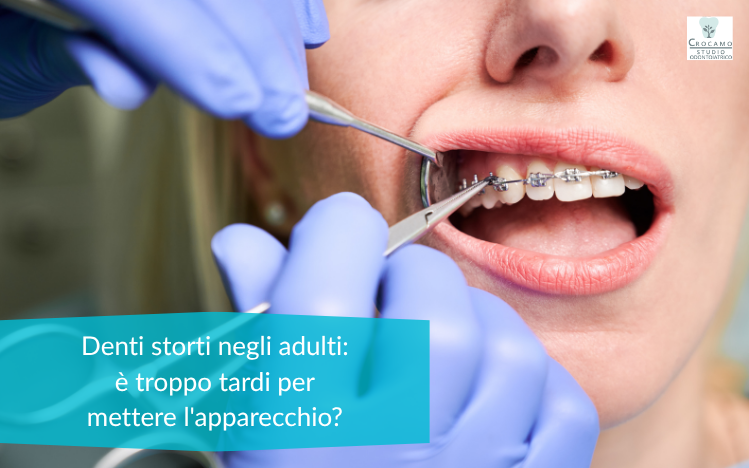 denti storti adulti
