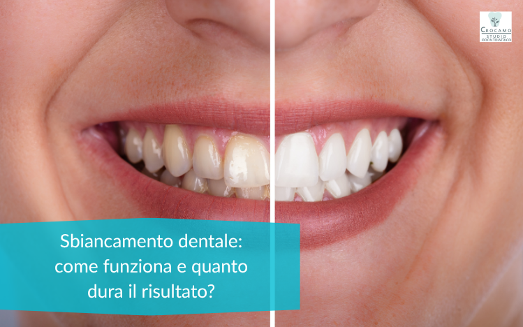 sbiancamento-dentale